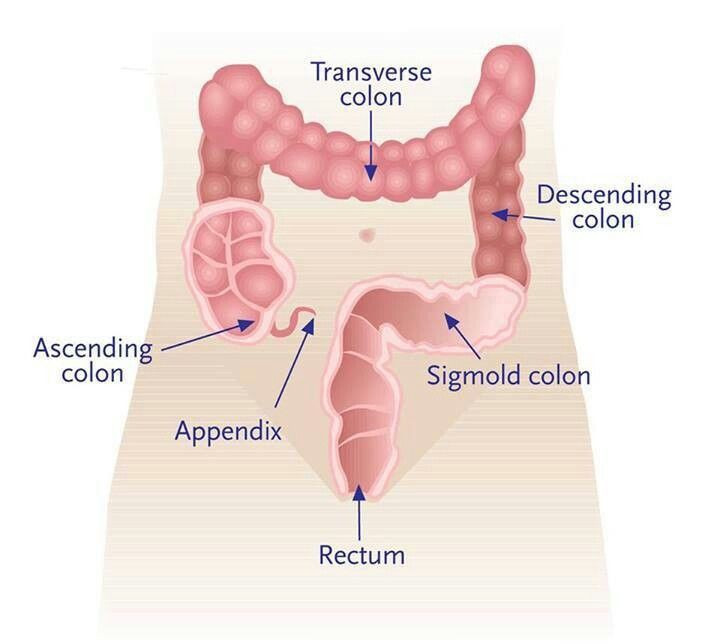 Colectomia